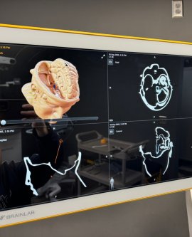 Beyin Cerrahi  NöroNavigasyon