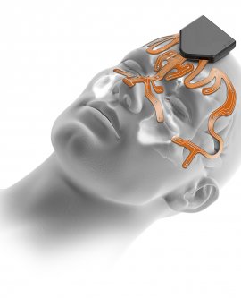 Beyin Cerrahi  NöroNavigasyon